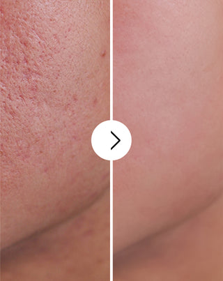 Akne, näppylät ja epätäydellisyydet tabletit, joissa on sinkkiä, C-, E- ja B2-vitamiinia Derminax_4 - 4