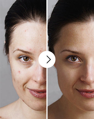 Akne, näppylät ja epätäydellisyydet tabletit, joissa on sinkkiä, C-, E- ja B2-vitamiinia Derminax_3 - 3