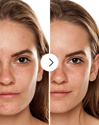 Akne, näppylät ja epätäydellisyydet tabletit, joissa on sinkkiä, C-, E- ja B2-vitamiinia Derminax_2 - 2