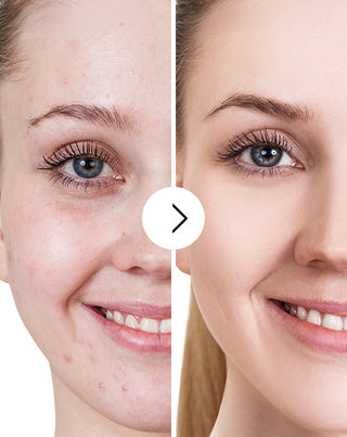 Akne, näppylät ja epätäydellisyydet tabletit, joissa on sinkkiä, C-, E- ja B2-vitamiinia Derminax_5 - 5