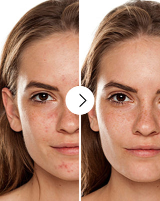 Akne, näppylät ja epätäydellisyydet tabletit, joissa on sinkkiä, C-, E- ja B2-vitamiinia Derminax_2 - 2