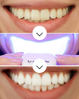 Hampaiden valkaisusetti, jossa LED-valaisin ja Light & Bright Smilebite -valkaisugeeli. - 3